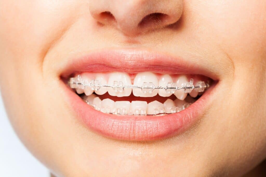 Braces In Metairie LA