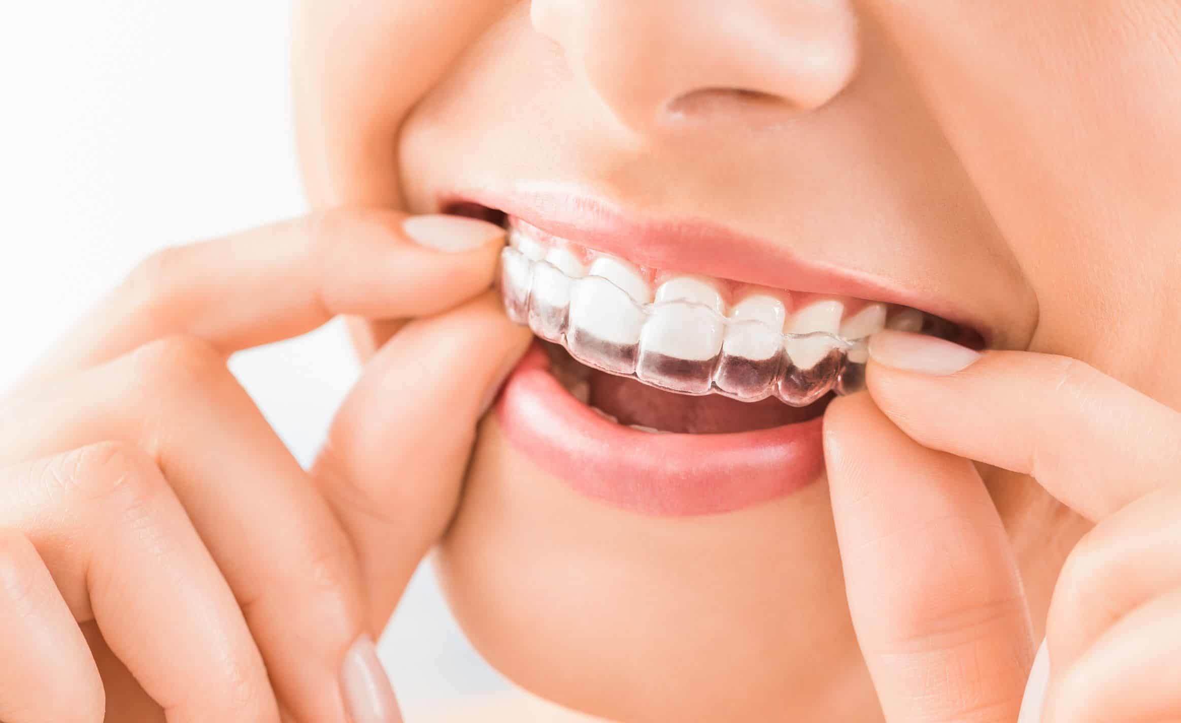 Invisalign Provider Lakeview