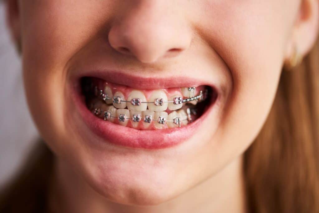 Braces In Jefferson, LA